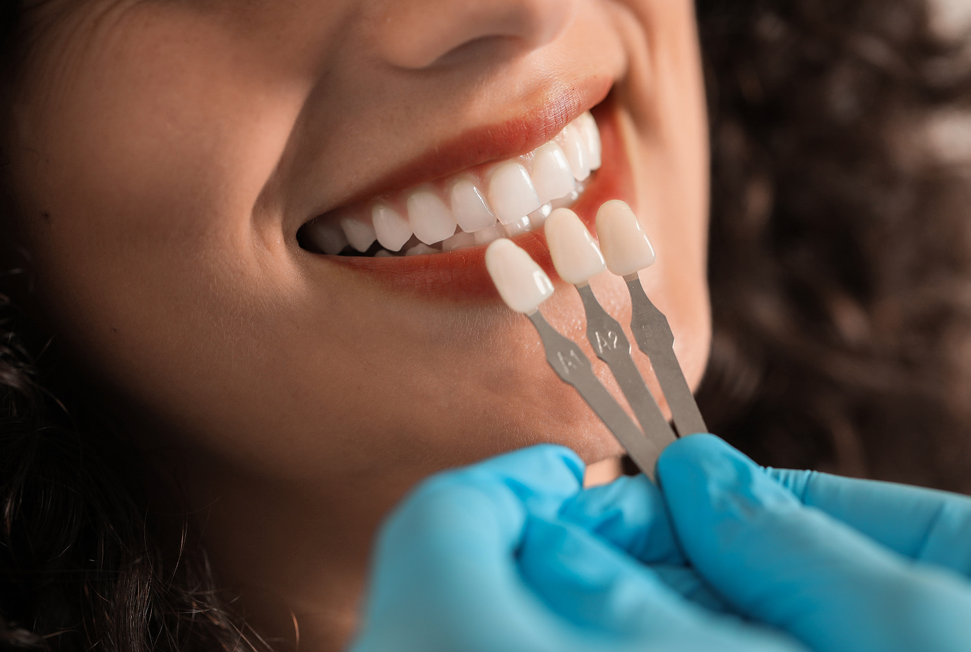 No-Prep Veneers