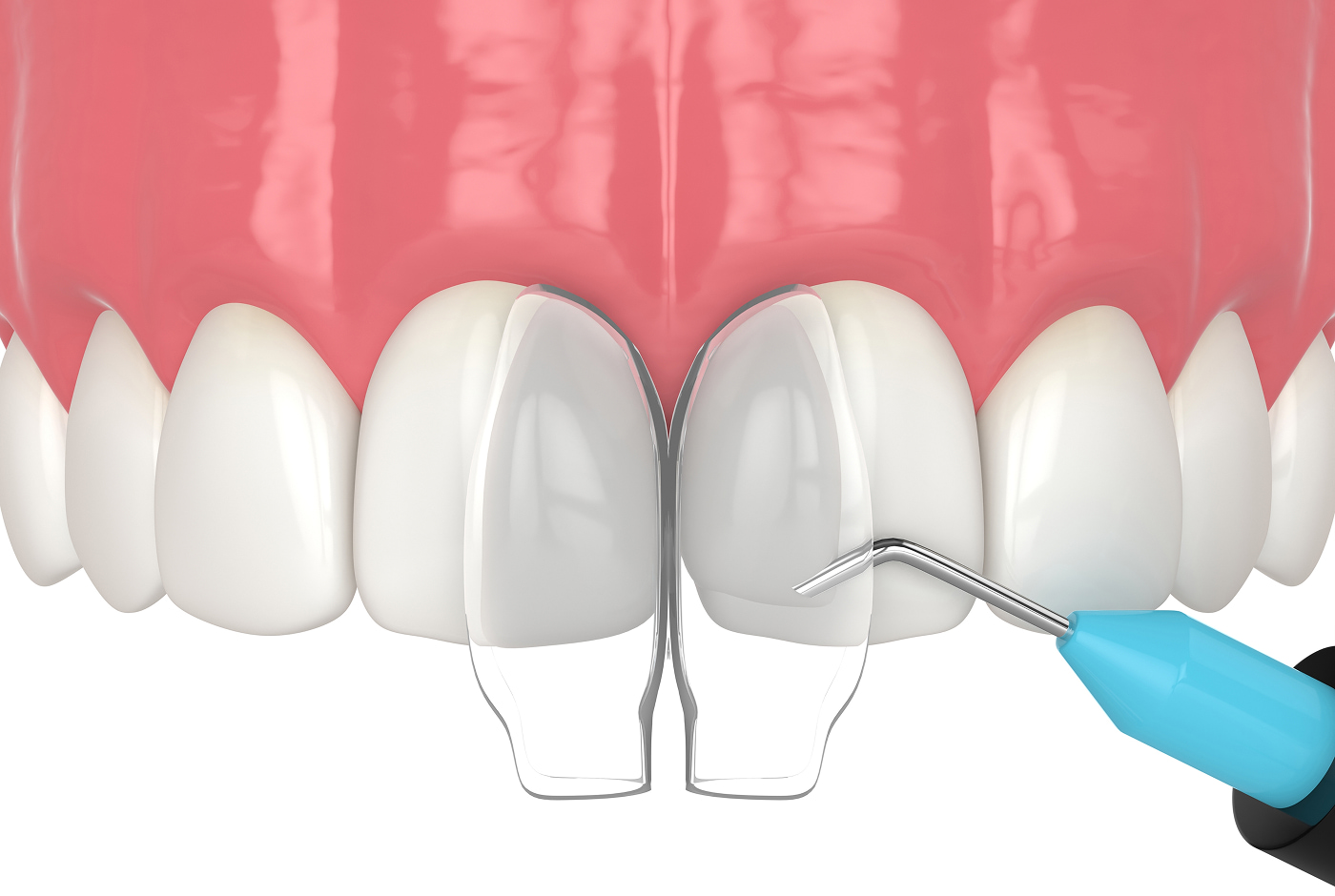 Cosmetic Bonding