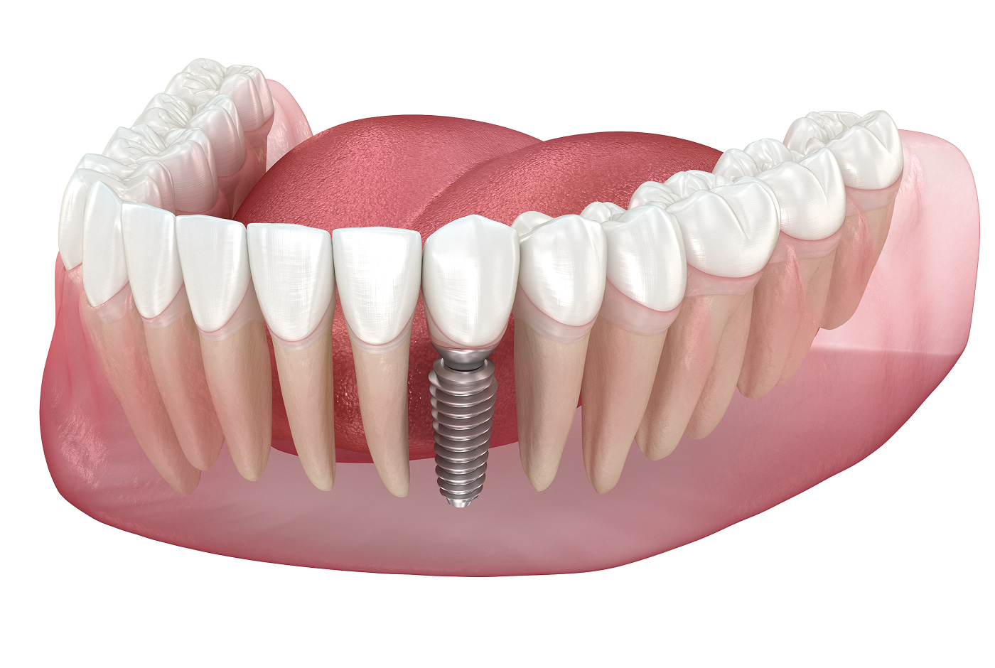 Dental Implants for Single-Tooth Aesthetics